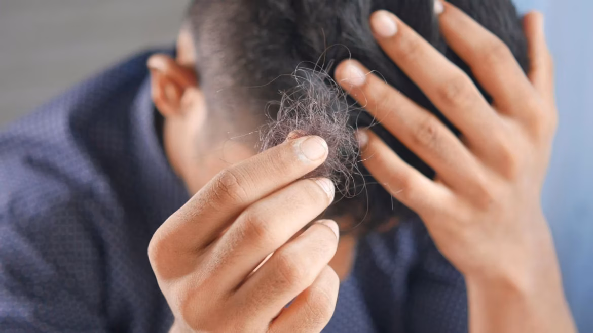 Barely 20 and Already Losing Hair: Inside Gen Z’s Growing Hair Loss Crisis